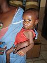 2 Dihydrated kid in Sodefor hospital in Nioki